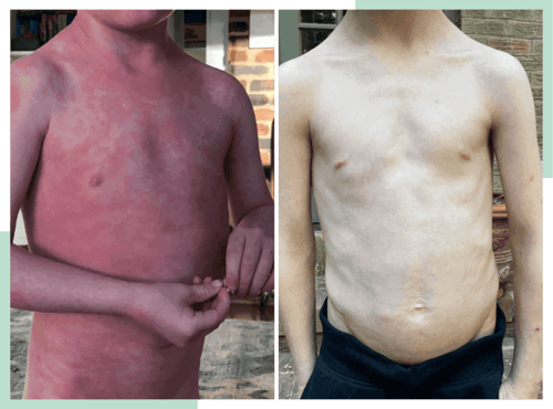 dr-ana-eczema-transformations-1-1--1024x759