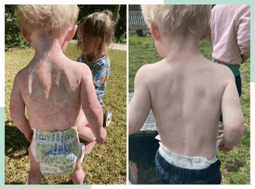 dr-ana-eczema-transformations-2-1-