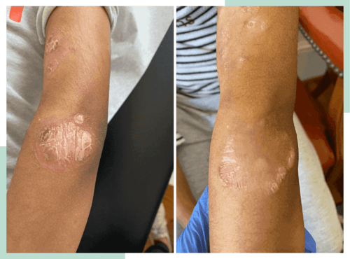 dr-ana-eczema-transformations-3-1--1024x759