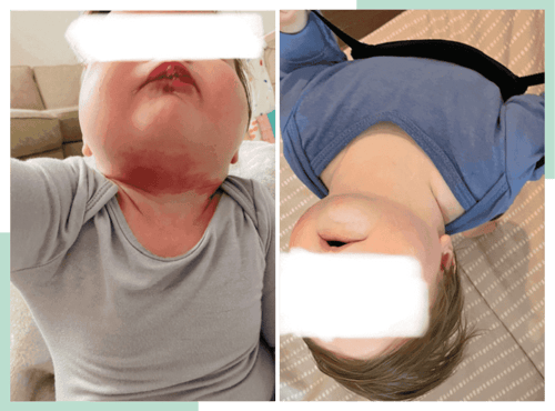 dr-ana-eczema-transformations-4-1--1024x759